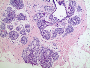 Ductales Carcinoma in situ (H&E)